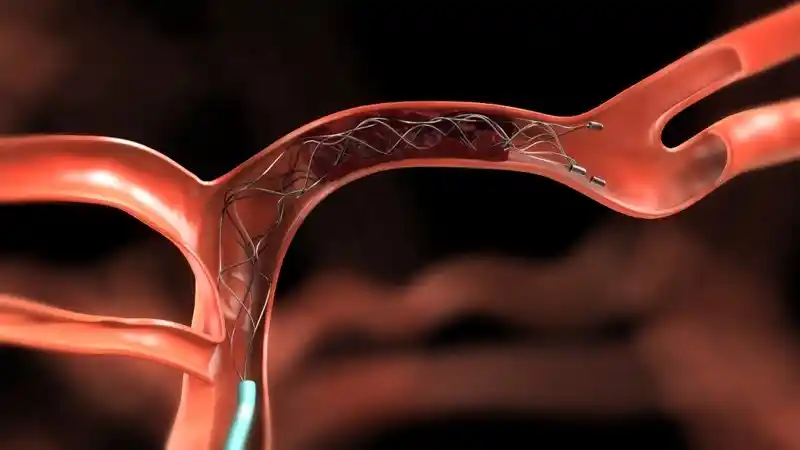 What is Mechanical Thrombectomy?
