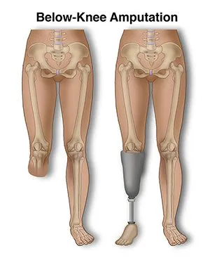 Minor Amputations