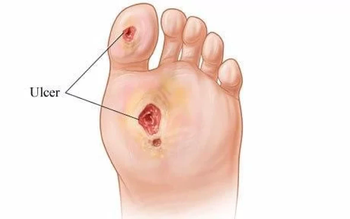 Diabetic foot ulcers