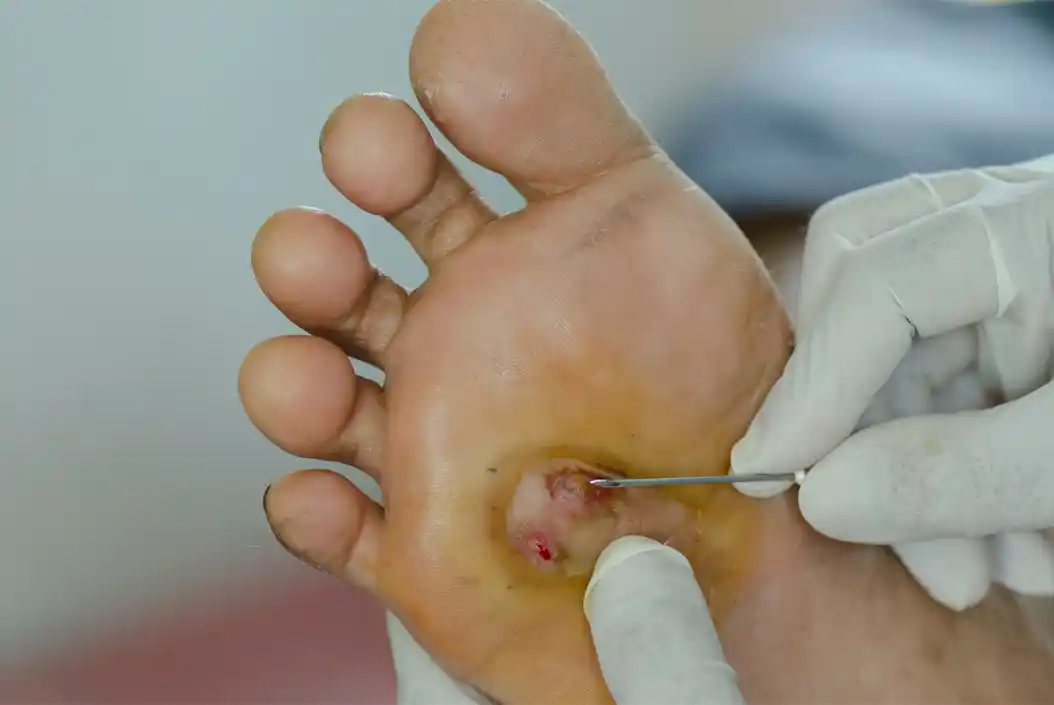 What Are Revascularization Procedures?
