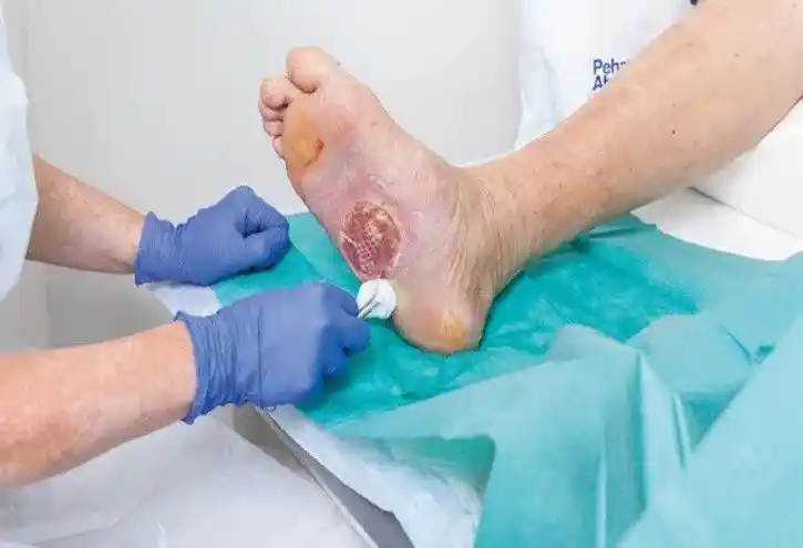 Advanced Wound Debridement Treatment in Mohali