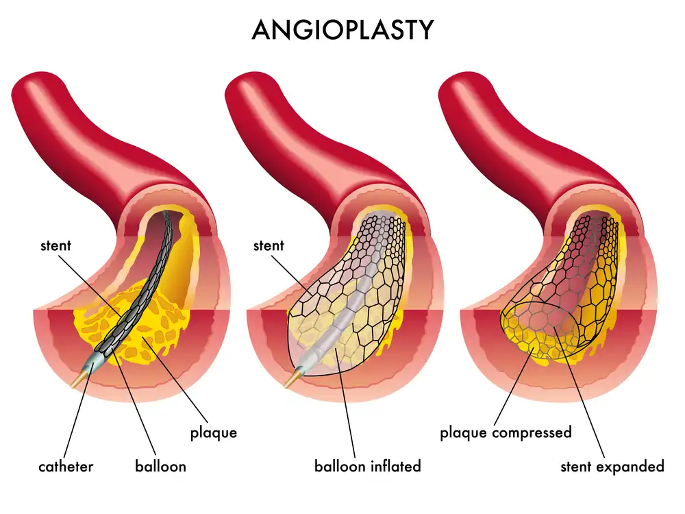 What is Peripheral Angioplasty?