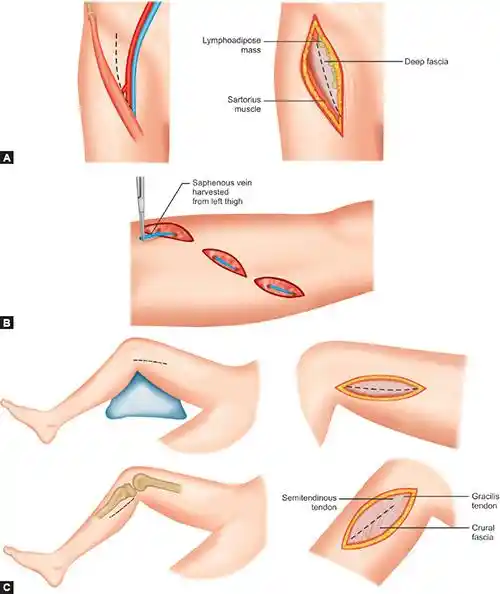 Fem-Pop Bypass