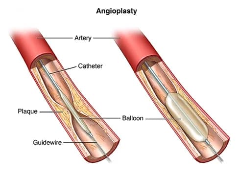 What is Peripheral Angioplasty?