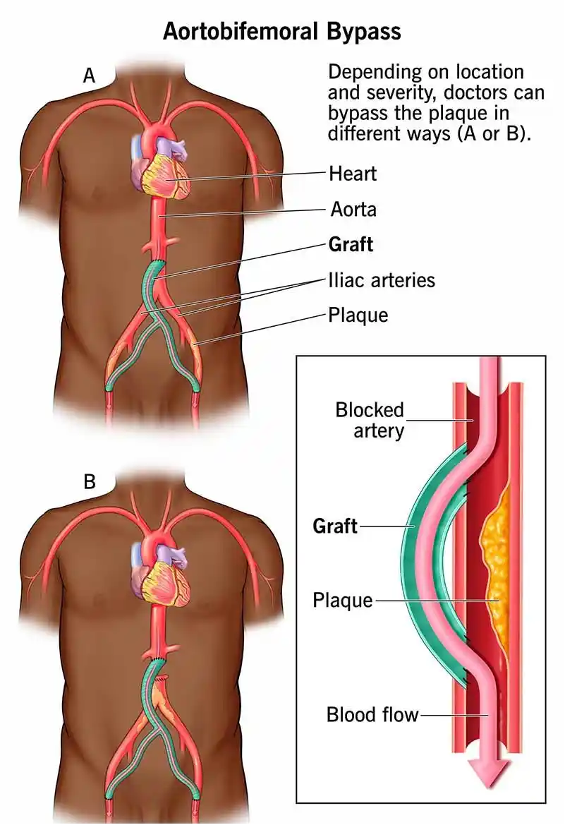 What is Aorto-Femoral Bypass Surgery?