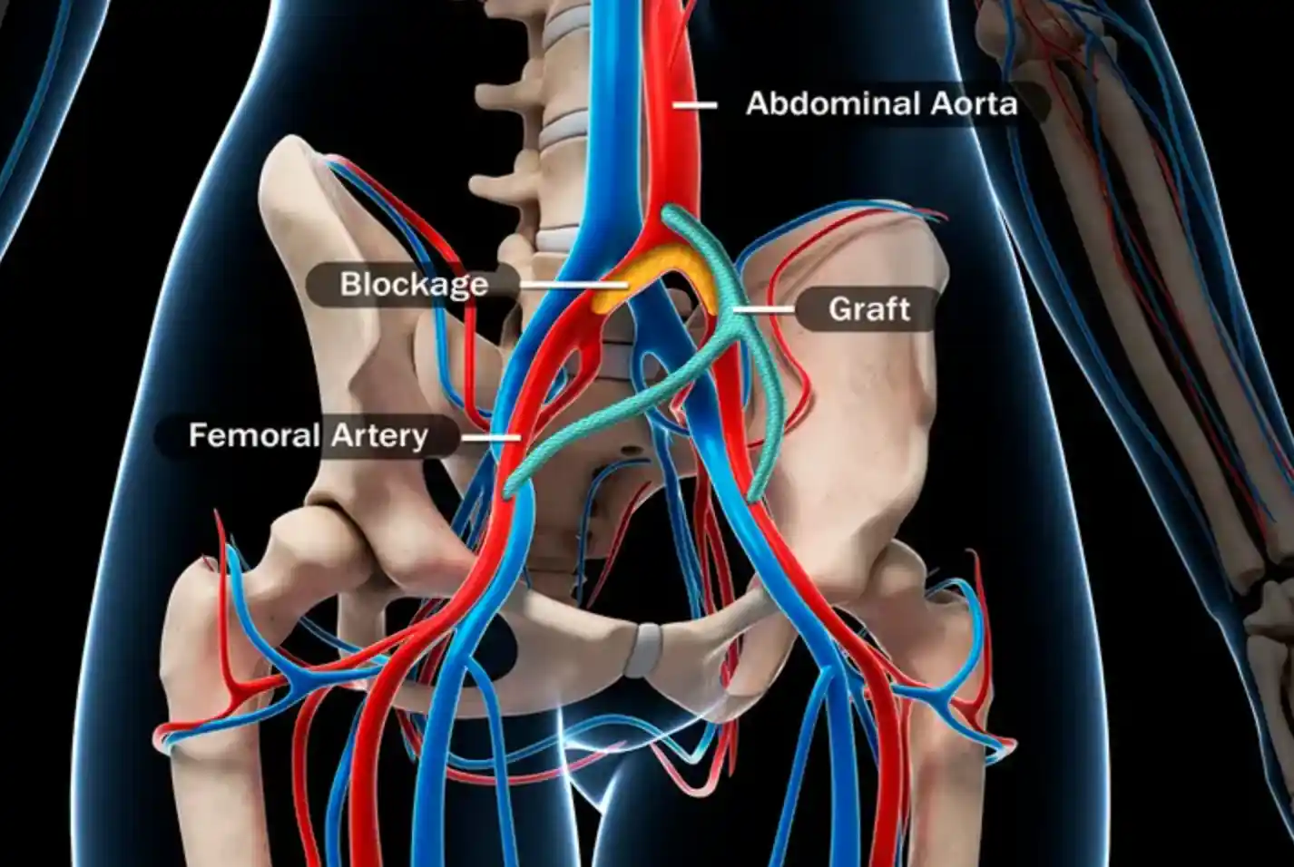 Aorto-femoral Bypass