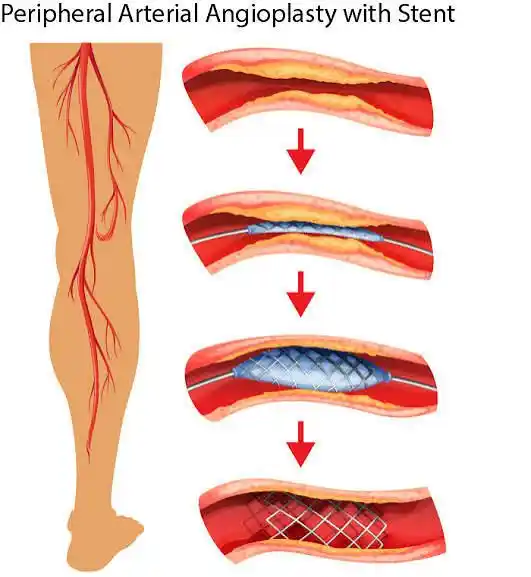 What Is Peripheral Stenting?