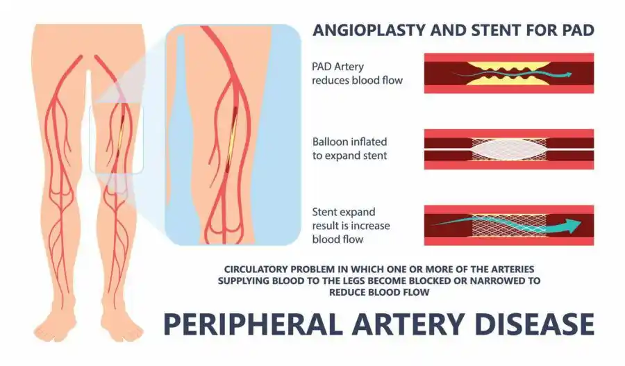 Peripheral Stenting