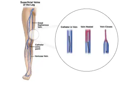 What Is Radiofrequency Ablation (RFA)?