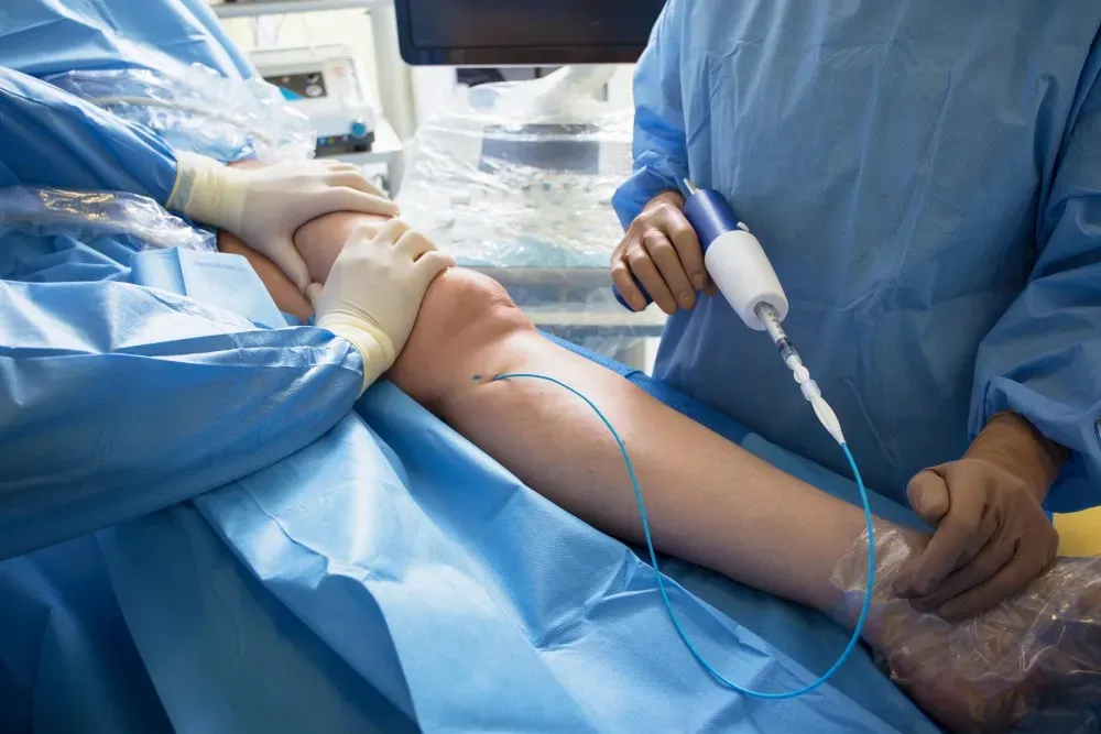 Glue Therapy (VenaSeal)