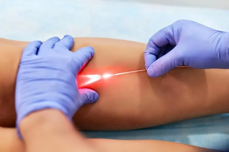 Varicose Veins Laser Treatment in Mohali