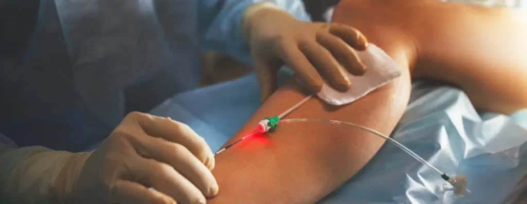 Simple Laser Treatment (EVLT)