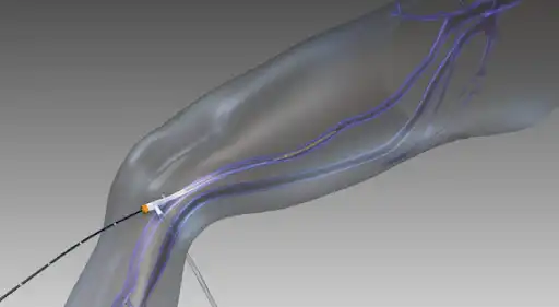Radiofrequency Ablation (RFA)
