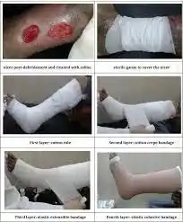 What Is Venous Recanalization?